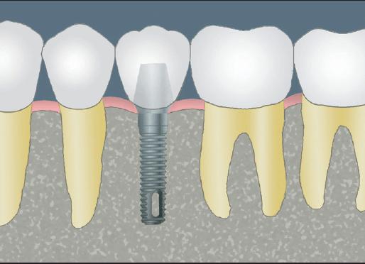 CCOFS Guide to Dental Implants