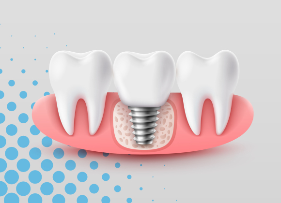 dental implant costs and factors