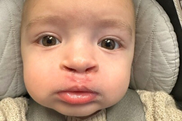 Cleft Surgery Patient After