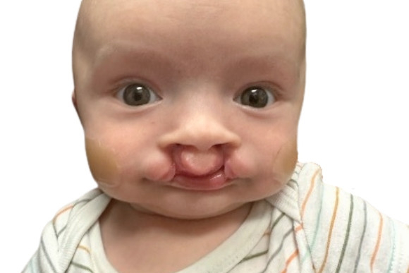 Cleft Surgery Patient Before