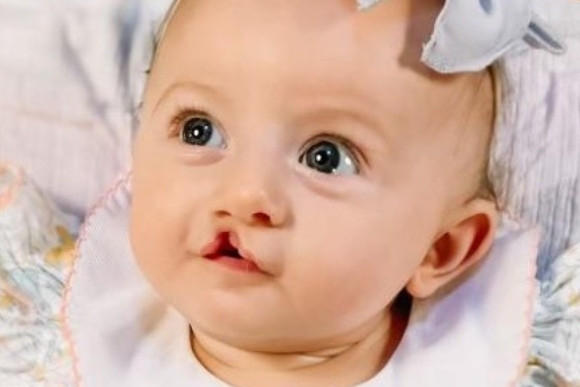 Cleft Surgery Patient Before