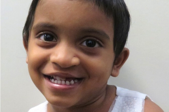 Cleft Surgery Patient After