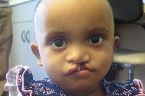 Cleft Surgery Patient Before