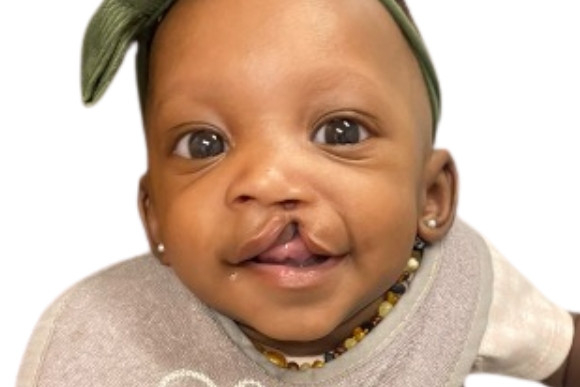 Cleft Surgery Patient Before