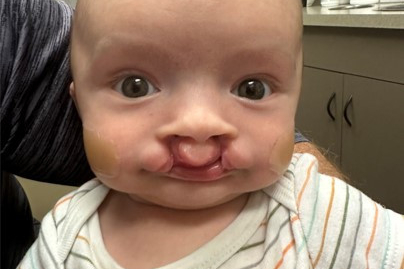 Cleft Center Patient CCOFS