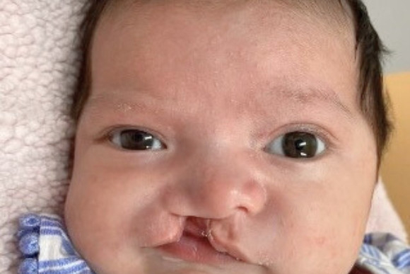 Cleft Surgery Patient Before