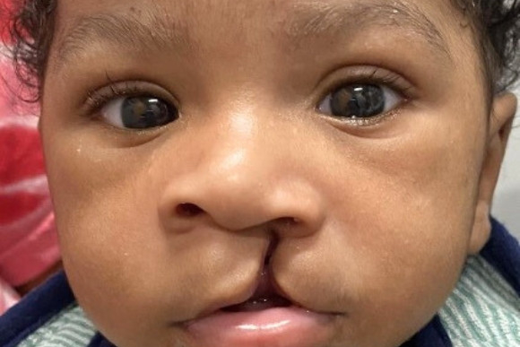 Cleft Surgery Patient Before