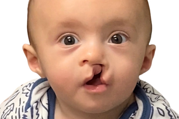 Cleft Surgery Patient Before