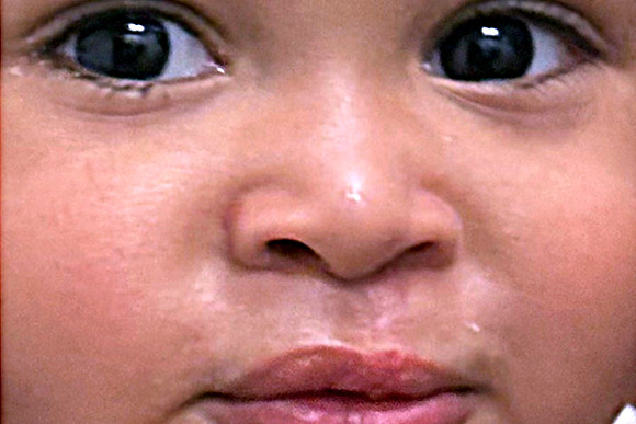 Cleft Surgery Patient After