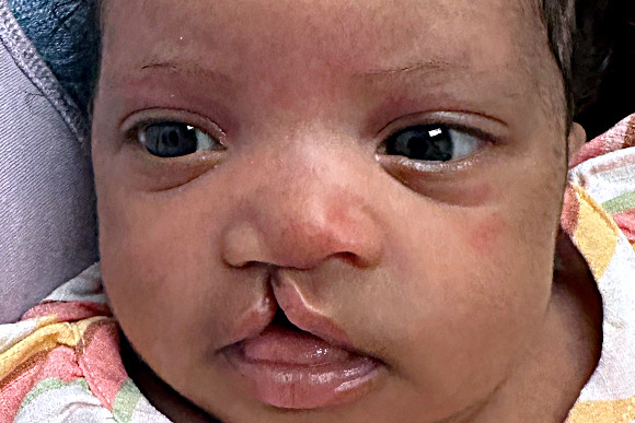 Cleft Surgery Patient Before