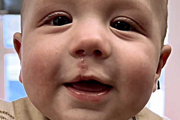 Cleft Surgery Patient After