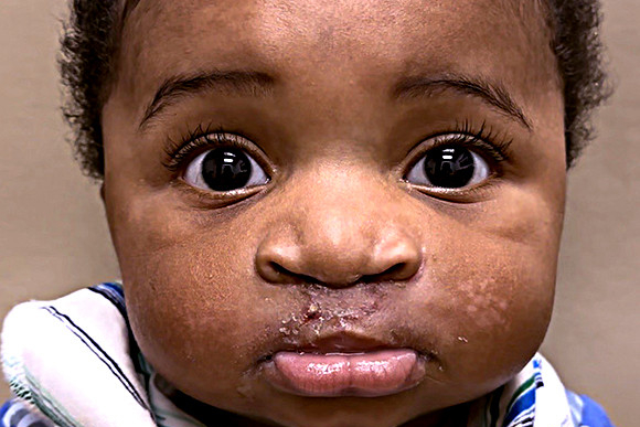 Cleft Surgery Patient After