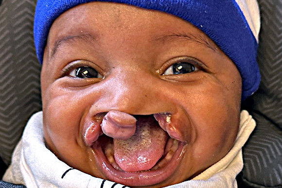 Cleft Surgery Patient Before