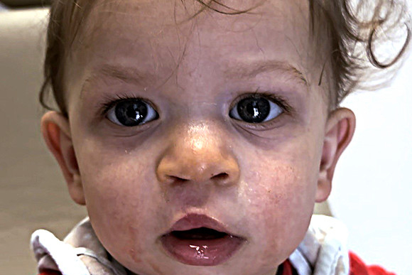 Cleft Surgery Patient After