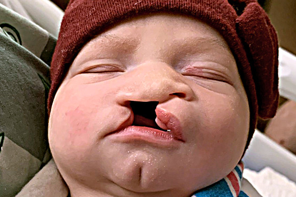 Cleft Surgery Patient Before