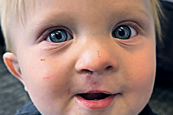 Cleft Surgery Patient After