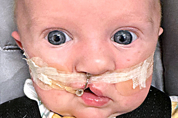 Cleft Surgery Patient Before