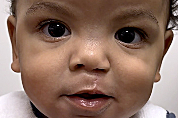 Cleft Surgery Patient After