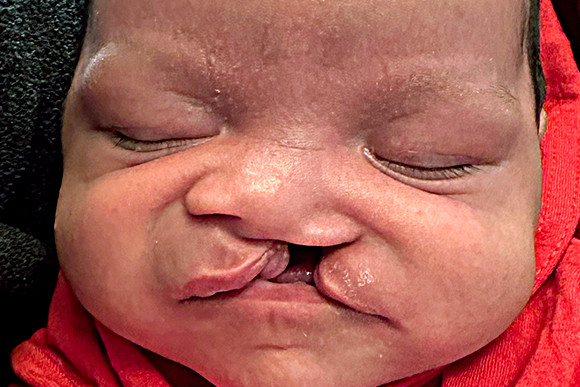 Cleft Surgery Patient Before