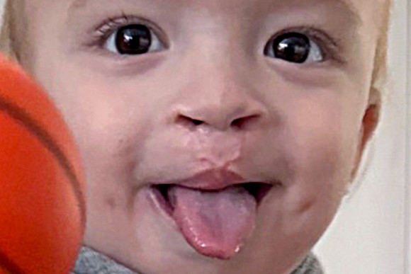 Cleft Surgery Patient After