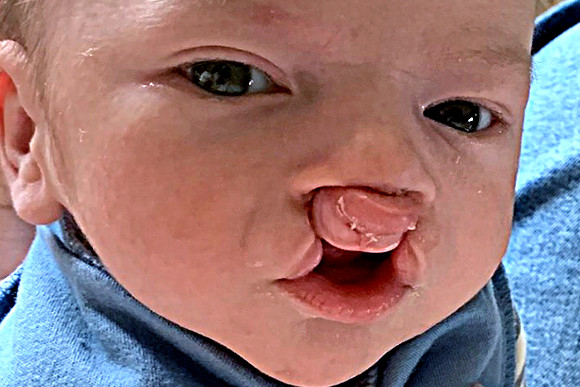 Cleft Surgery Patient Before