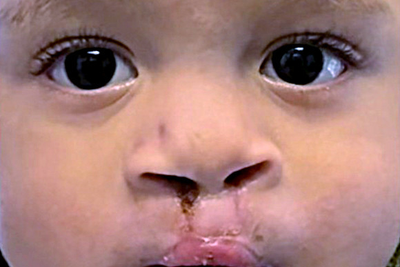 Cleft Surgery Patient After