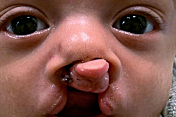 Cleft Surgery Patient Before