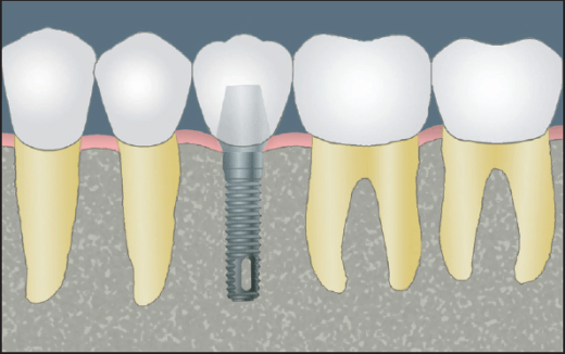 CCOFS Guide to Dental Implants