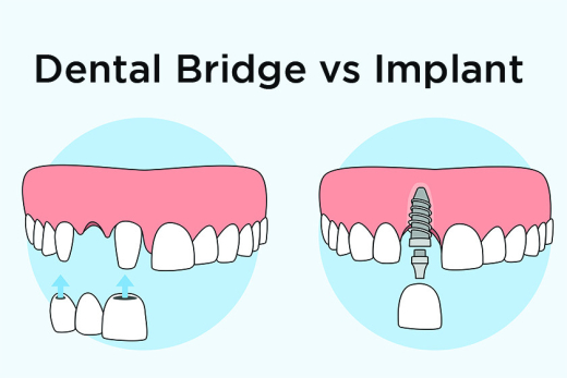 Dental Bridge vs. Dental Implant for Tooth Replacement