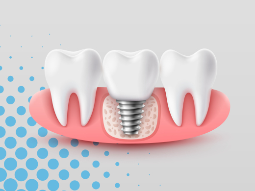 A graphic illustration of the structure of a dental implant, including the titanium post, abutment, and crown