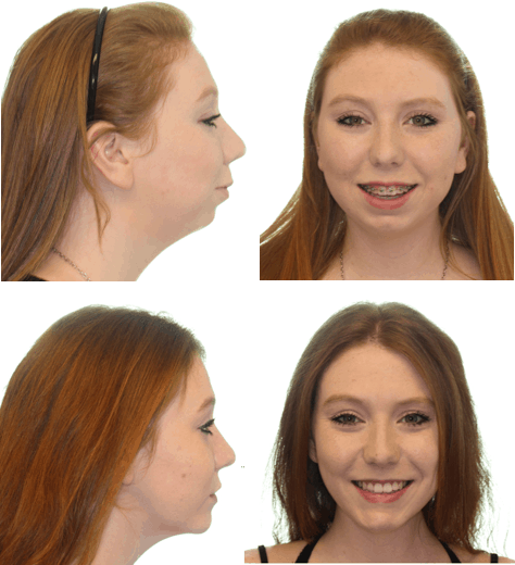 CCOFS Digital Planning for Jaw Surgery