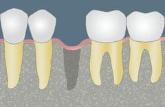 CCOFS Guide to Dental Implants