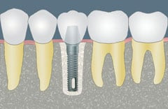 CCOFS Guide to Dental Implants