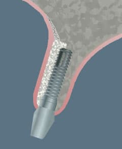 CCOFS Guide to Dental Implants