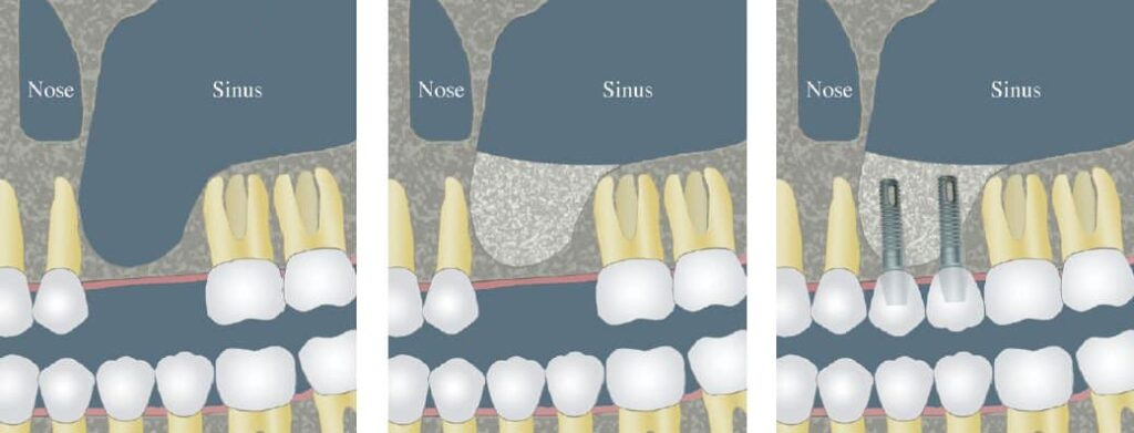 CCOFS Guide to Dental Implants