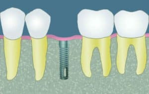 CCOFS Guide to Dental Implants