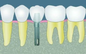 CCOFS Guide to Dental Implants