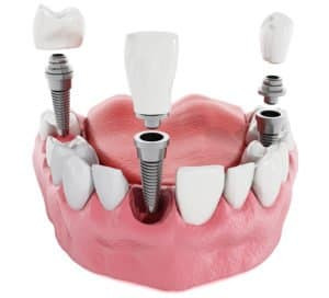 CCOFS Types of Dental Work