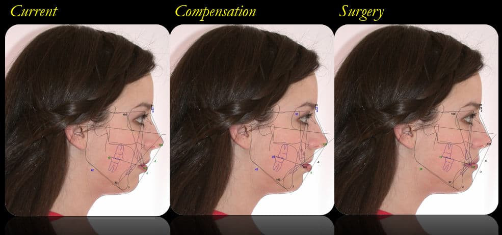 CCOFS Digital Planning for Jaw Surgery