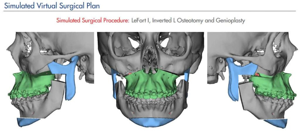 CCOFS Digital Planning for Jaw Surgery