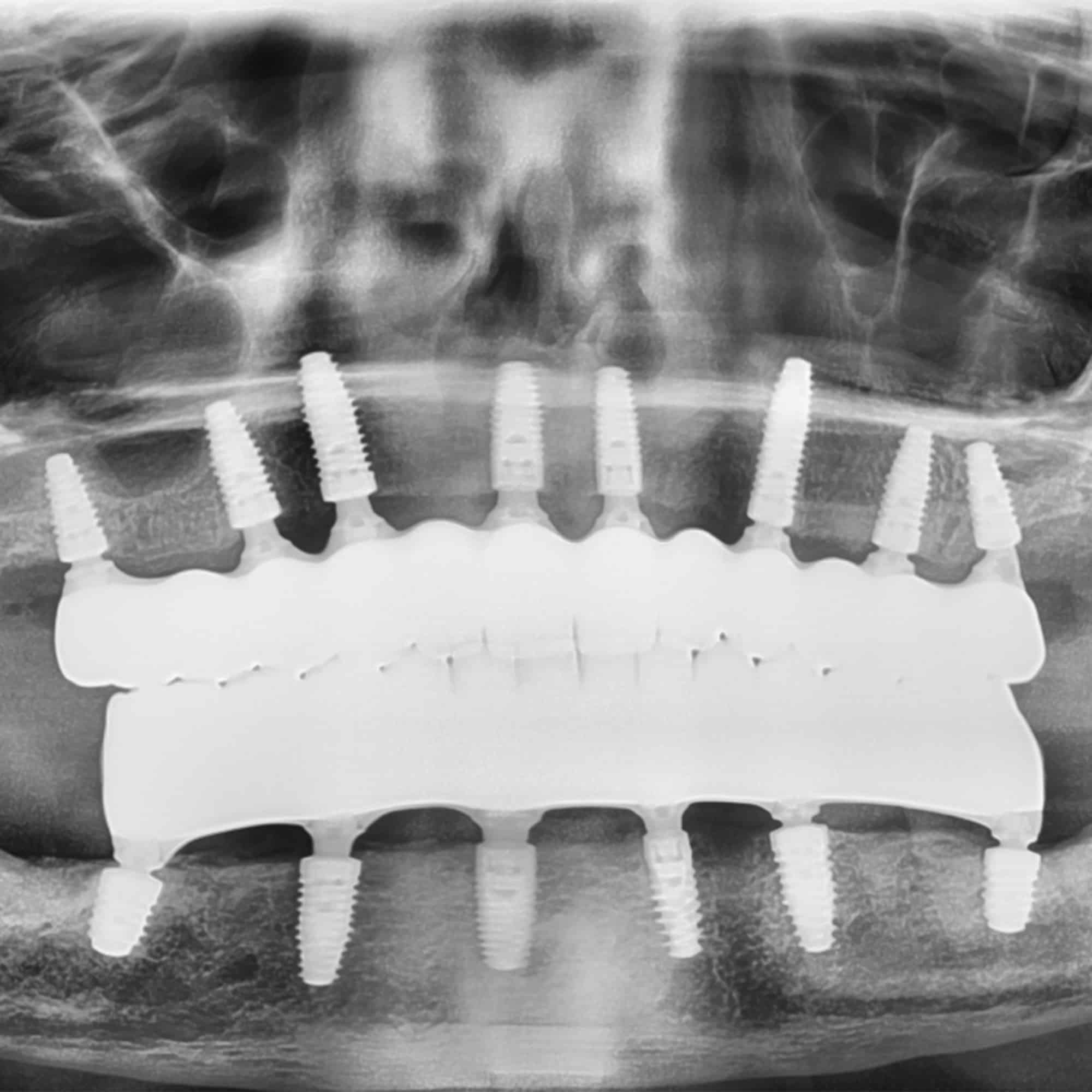 Dental X-ray showing an upper jaw with multiple implants and screws, aligned for prosthetic teeth replacement, against a clear background.