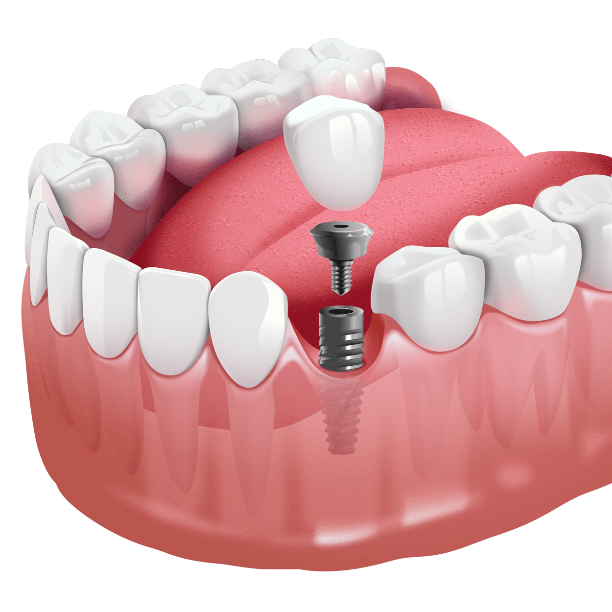An illustration of a dental implant procedure, showing an implant being inserted into the gum with a crown, surrounded by teeth and gums.