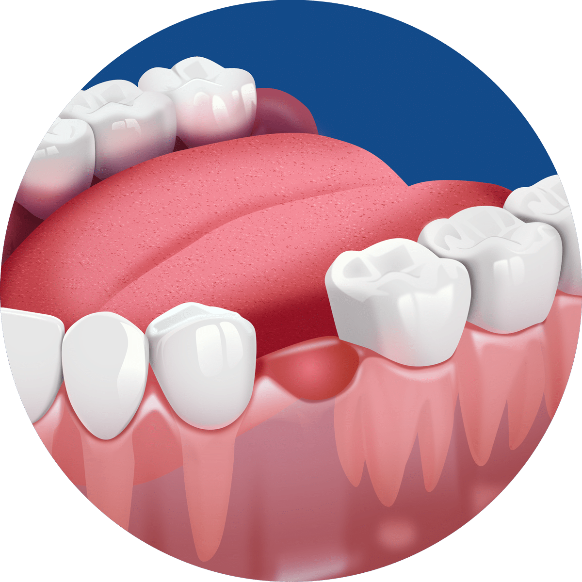 An illustration of human gums, showing teeth and an exposed socket, with the tongue visible in a circular frame on a blue background.