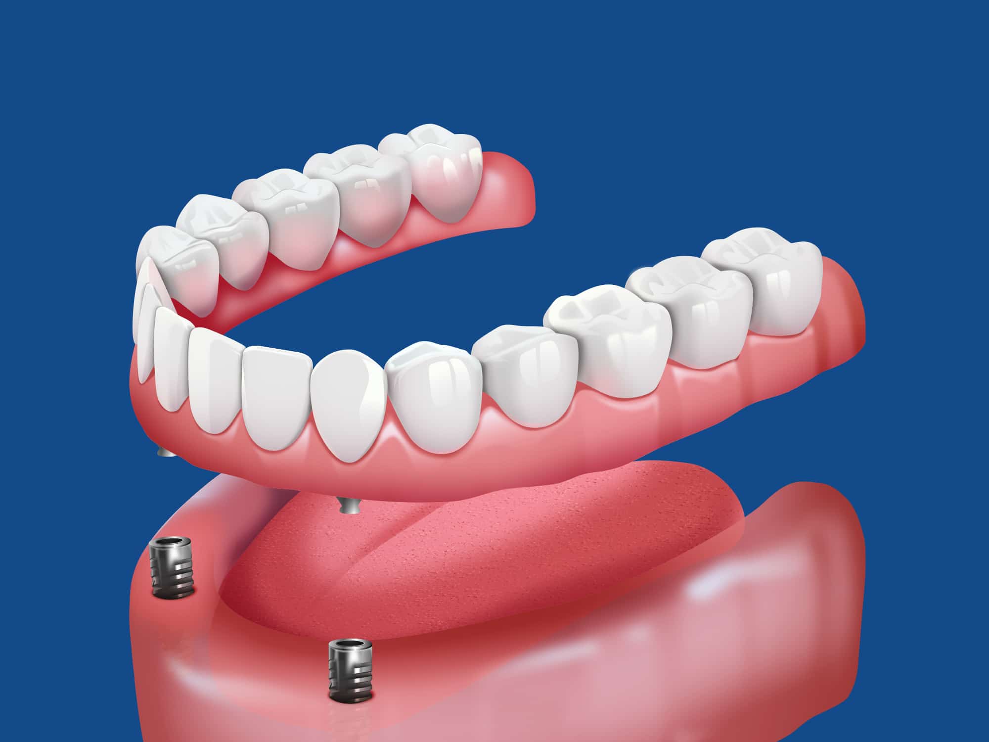 Illustration of dental implants in pink gums, with realistic upper and lower white teeth, set against a solid blue background.