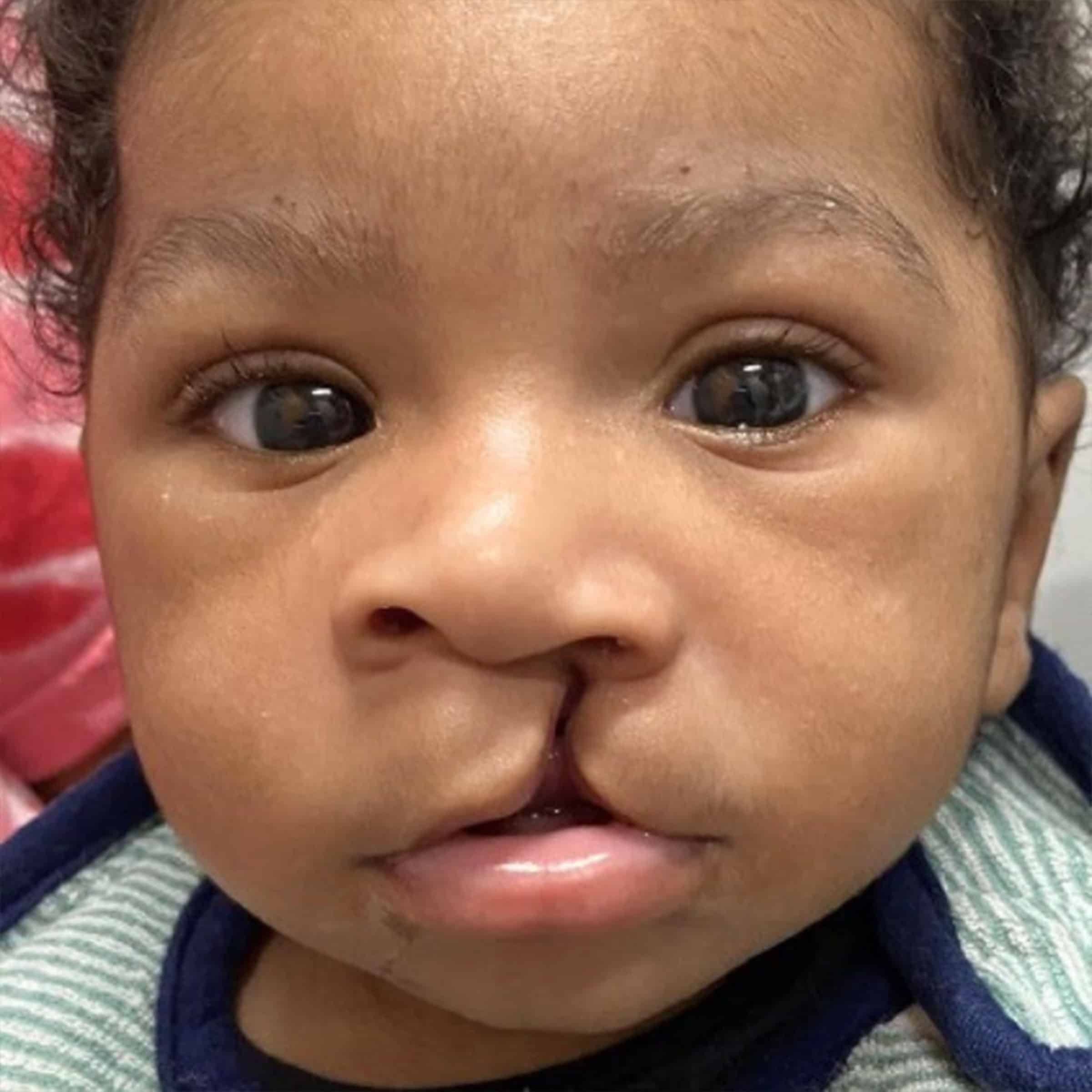 A baby with a cleft lip looks directly at the camera, wearing a striped outfit. Background includes a pink and white pattern.