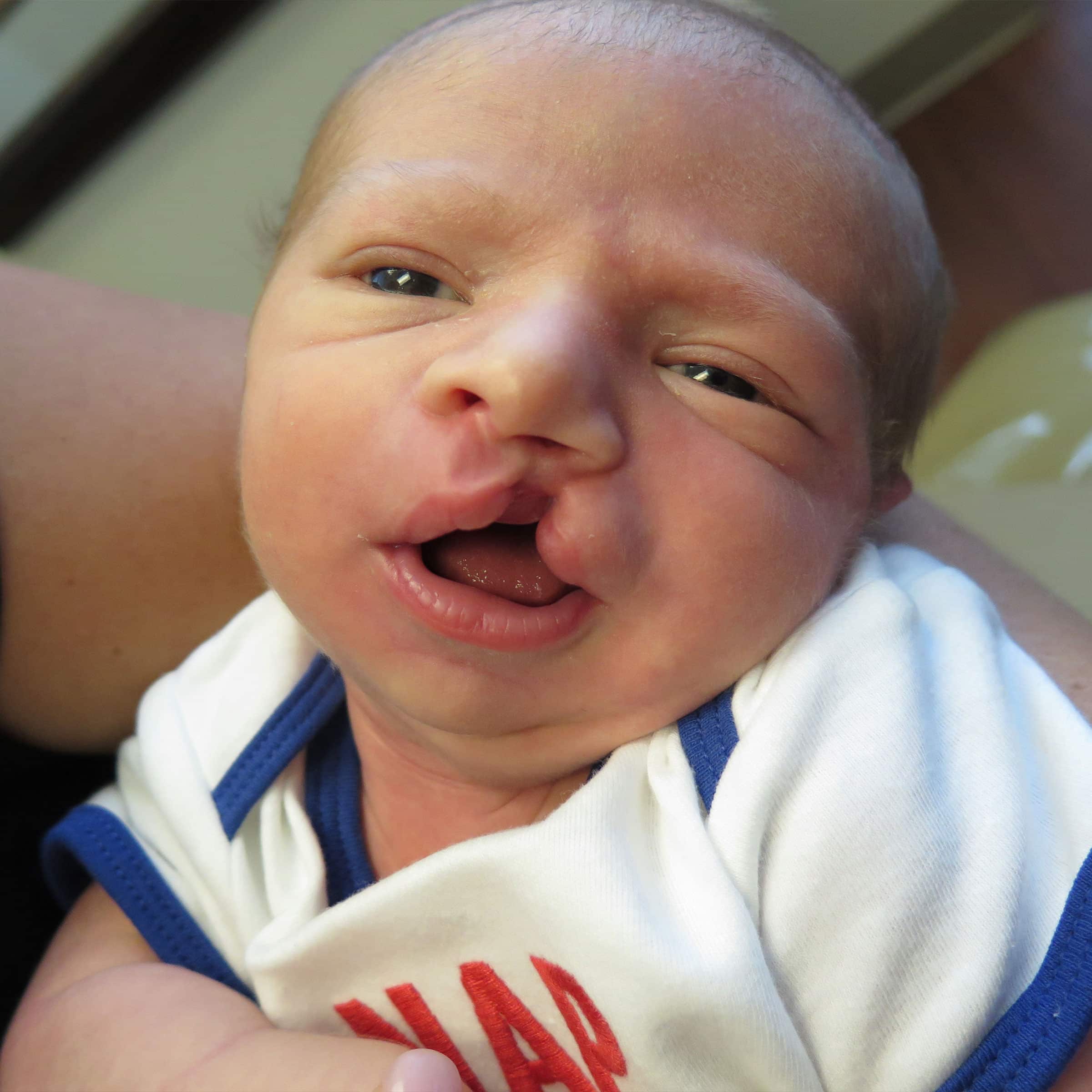 A close-up of a newborn baby with a cleft lip, wearing a white and blue outfit. The baby is being held by a person.