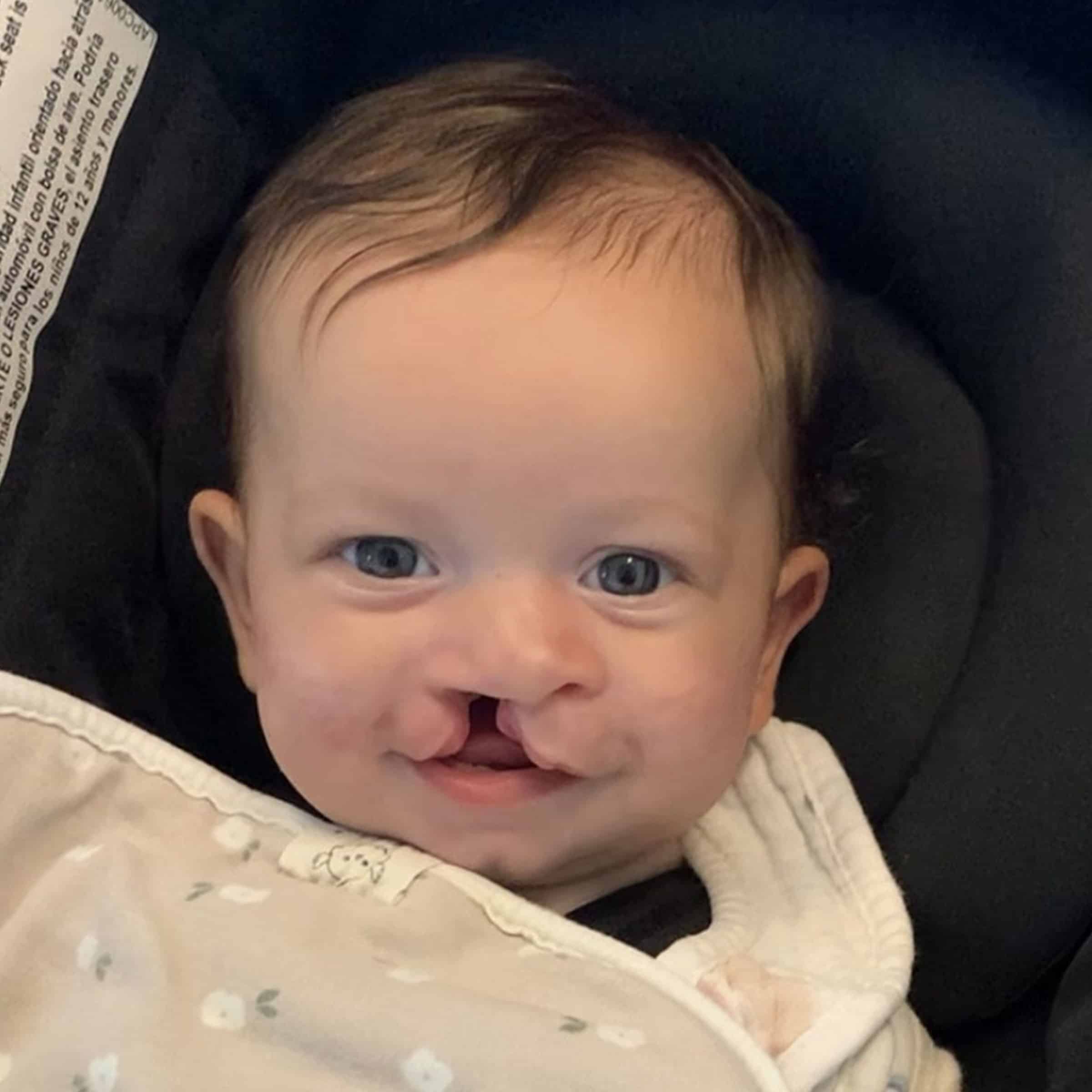 A baby with a cleft lip smiles, wrapped in a floral blanket, seated in a stroller. No landmarks or historical buildings present.