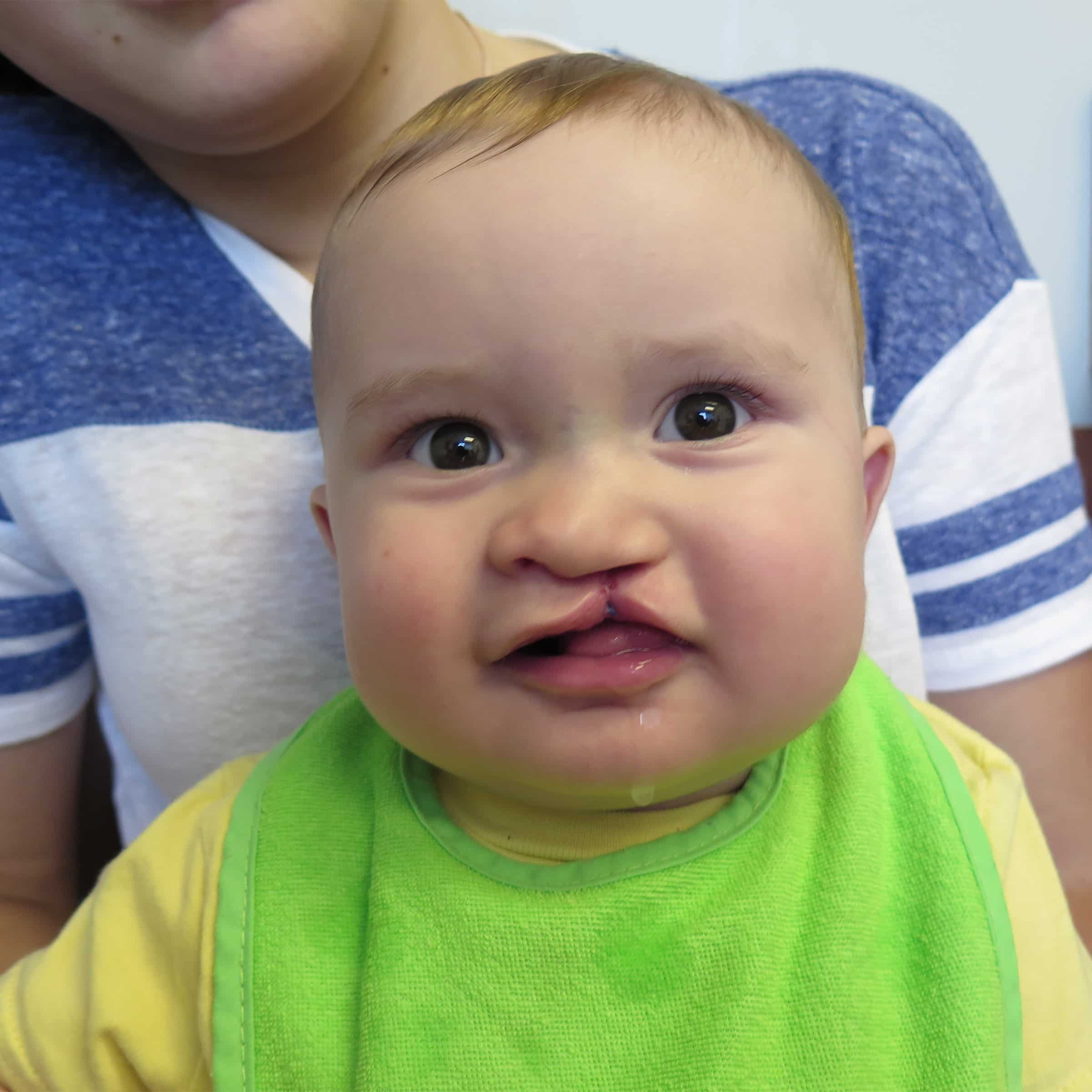 A baby with a repaired cleft lip wears a bright green bib, held by a person in a blue and white shirt.