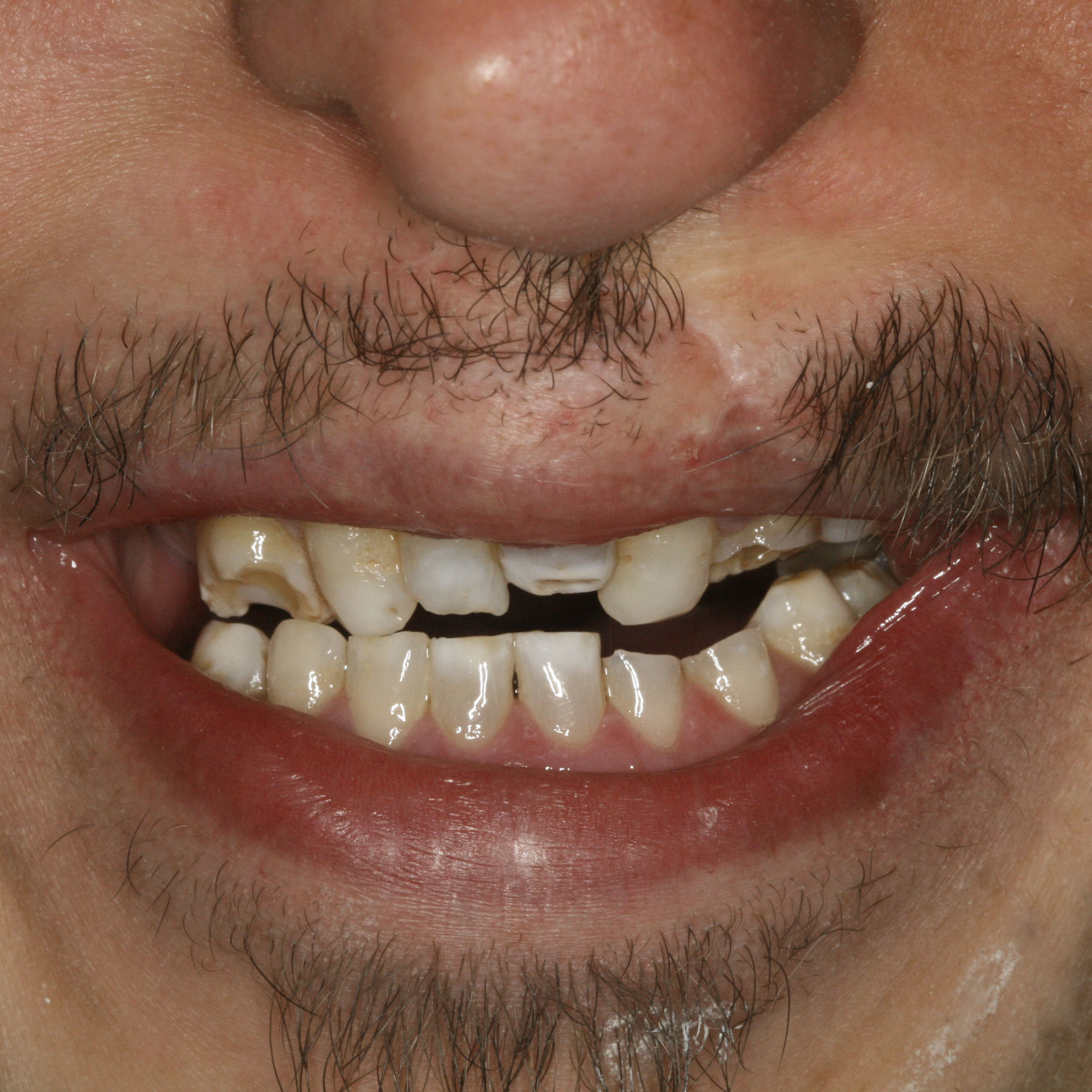 Full mouth dental implants transformation - before