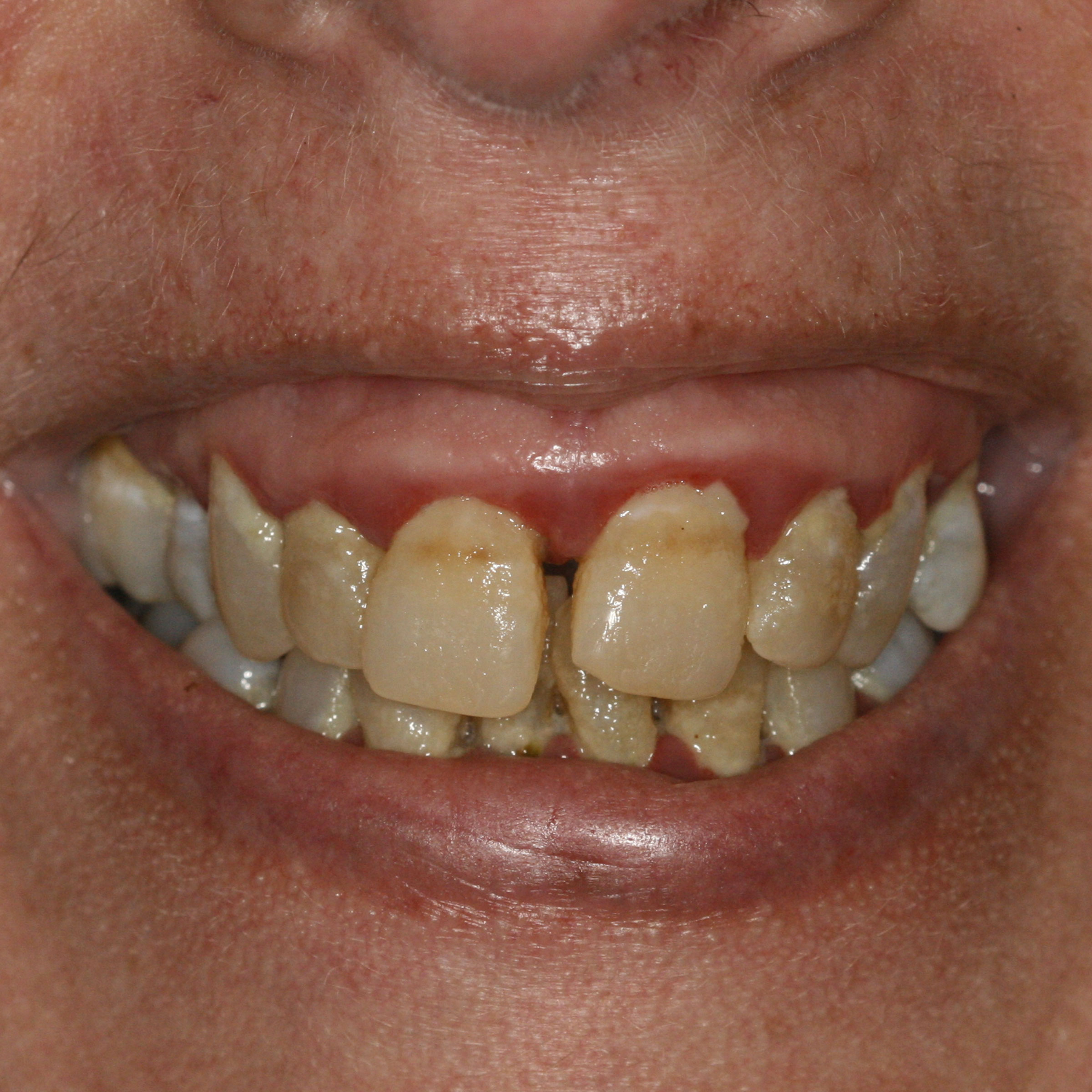 Full mouth dental implants transformation - before